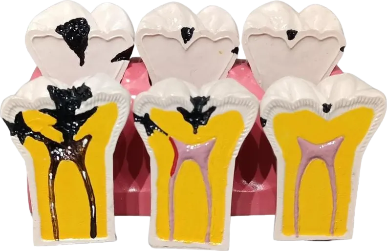 İDA Çürük Diş Modeli